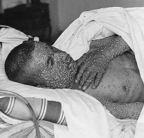 Image for: Benjamin Colman: Some Observations on Receiving the SMALL-POX by Ingrafting or Inoculating